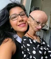 The little girl in the photo passed away a few years ago. I used to follow  her