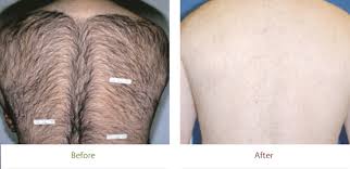 So, ipl and laser hair removal is not recommended for teens. Laser Hair Removal El Dorado Hills Permanent Hair Reduction Folsom