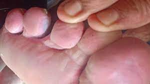 Jangkitan ulat air atau nama lain yang biasa kita dengar 'kaki makan air' adalah satu penyakit kulit. Penyakit Kulat Air Boleh Cepat Sembuh Psherbs