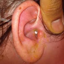 Image result for Acute Otitis Externa