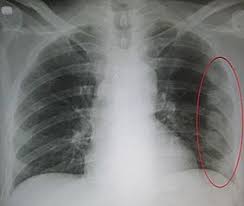 Flail Chest Physiopedia