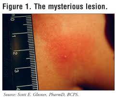 Some women with ibc also notice thickened or discolored breast skin with tiny dimples, puckers, or ridges that make it look like an orange peel. Pyemotes The Mysterious Itch Mite
