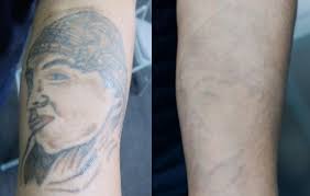 Call today for a free consultation!. San Pablo Edc Offers Low Cost Tattoo Removal Richmond Standard