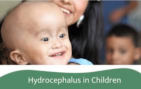 Image result for Hydrocephalus