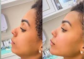 A cirurgia que reduz as bochechas medo de dentista.bichectomia: Brunna Goncalves Mostra Antes E Depois De Harmonizacao Facial Gq Musa