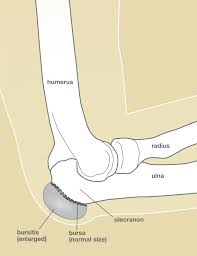 The causes of golfer's elbow are similar to tennis elbow but pain and tenderness are felt on the inside (medial) of the elbow, on a lump can often be seen and the elbow is painful at the back of the joint. Olecranon Bursitis