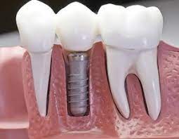 When Deciding Between A 3 Unit Bridge Vs A Dental Implant Crown Remember The Implant And Crown Will L Teeth Implants Mini Dental Implants Tooth Implant Cost