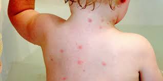 See full list on webteb.com Ù…Ø±Ø¶ Ø§Ù„Ø¬Ø¯Ø±ÙŠ Ø£Ø³Ø¨Ø§Ø¨Ù‡ ÙˆØ£Ø¹Ø±Ø§Ø¶Ù‡ ÙˆØ·Ø±Ù‚ Ø§Ù„ÙˆÙ‚Ø§ÙŠØ©