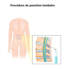 • vertèbre lombaire > de • vertèbre lombaire > en • vertèbre lombaire > es. Ponction Lombaire Pourquoi Techniques Douleur