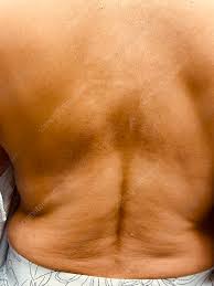 Image result for Notalgia Paresthetica