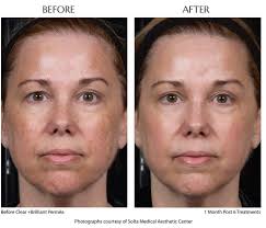 Solta's portfolio includes the thermage rf systems, fraxel laser, clear + brilliant laser and vaser ultrasonic systems. Clear And Brilliant Flathead Laser Hair Removal Kalispell Med Spa Coolsculpt Whitefish Botox Laser Cosmetic Center