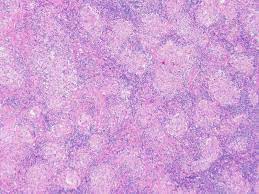 It level plodovnica po kapljicah sunday funday ex 2012 tarik phillips wvu scottish wool, per fisher. Hematopathology Case Study A 36 Year Old Woman With An Incidental Neck Mass Lablogatory