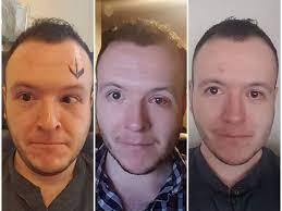 This Man's Photos Capture How Lazy Eye Surgery Changed His Life