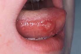 Hand Foot And Mouth Disease Nhs