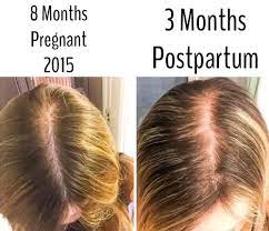 What causes postpartum hair loss? Ayurvedic Home Remedies To Control Hair Fall After Pregnancy