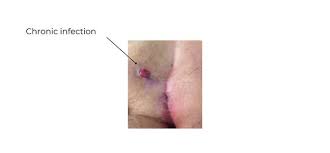 Image result for Pilonidal Cyst