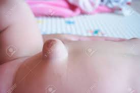 Sometimes the intestines get trapped within the umbilical hernia. Baby Navel With Umbilical Hernia Stock Photo Picture And Royalty Free Image Image 81290921