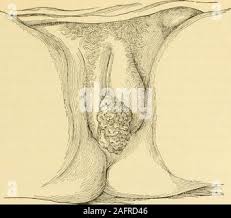 Image result for Vulvitis