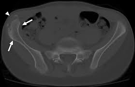 Image result for Hip Apophysitis