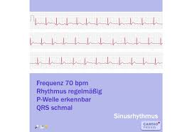 Normaler Puls Sinusrhythmus Smartphone Ekg Routinemessung Cardiopraxis