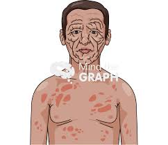 Hansen S Disease Man Body Front Mind The Graph