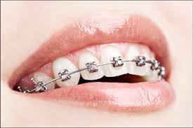 Many people wonder how much do invisible braces cost. Types Of Dental Braces In India The Dental Specialists