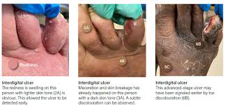 Image result for toe black diabetes