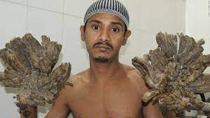 Hence, those affected by the ailment lack the ability to protect themselves from certain bacteria or viruses which, in the case of tree man syndrome, are human papillomavirus 10. Tree Man Syndrome Young Girl Diagnosed With Rare Condition Cnn