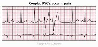 Ecg Interpretation 34 Coupled Pvc S Ecg Interpretation Ekg Interpretation Continuing Education For Nurses