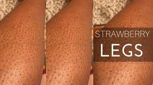 What Are Strawberry Legs Strawberry Leg Is A Condition You Experience When Little Black Dots Dark Strawberry Legs Get Rid Of Strawberry Legs Skin Care