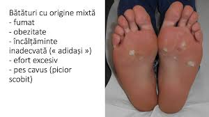 Care sunt cauzele apariţiei micozei pe talpa piciorului, între degetele de la picioare, pe palme, pe corp, înregiunea inghinală şi a organelor genitale? Bataturile Piciorului Cauze Si Tratament