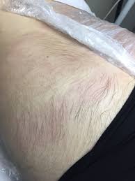 It's been around for nearly 150 years, making it an old form of hair removal. Journey Of A Young French Lady Professional Electrolysis Hairtell Hair Removal Forum By Andrea James