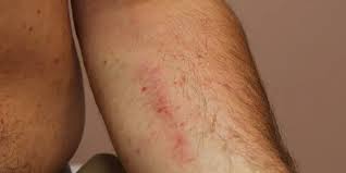 Image result for Urticaria pigmentosa children