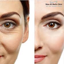 New Al Shefa Clinic Dubai • Filler • Botox • LASIK • Gyne | Blepharoplasty  Dubai | Eyelid Surgery | Eye Lift Surgery | New Al Shefa Clinic  Blepharoplasty usually involves the removal of excess fat... | Instagram