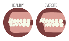 Not sure what sets you apart from other candidates? Overbite