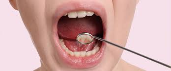 Image result for spinocellular carcinoma of the oral cavity