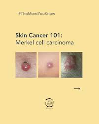 Image result for Merkel Cell Carcinoma