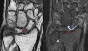 Image result for Scapholunate Dislocation