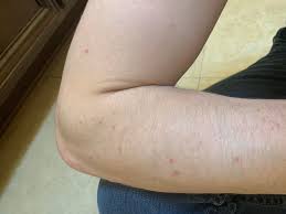 Use good quality aloe vera gel and apply a little to the armpit pimples. How To Get Rid Of These Little Red Bumps That Like To Pop Up On My Forearms Skincare Addiction