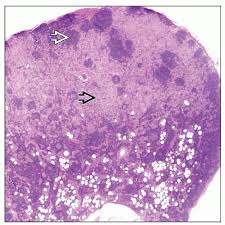Due to either the removal of lymph nodes or damage to the lymph system, your in cancer patients this is the result of either removal of the lymph nodes for cancer biopsy, radiation 2. Lymphadenopathy Associated With Joint Prostheses Basicmedical Key
