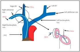 Although no one can be certain that costs are linear over the entire range of output or production, this is an assumption of cvp. Difficult Internal Jugular Central Venous Cannulation Using J Tip Guidewire With Indwelling Peripherally Inserted Central Venous Catheters