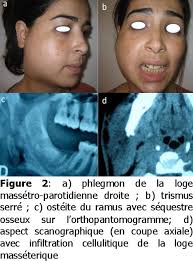 Image result for phlegmon on face)