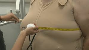Recovery After Breast Reduction Surgery | Edmonton-Plastic Surgeon