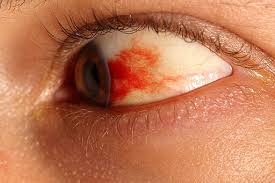 Image result for Acute Red Eye