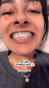 Her jaw is wired shut 😳 #jaw #wired #brace #Braces #braces