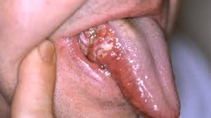Cancer can develop in almost any tissue or organ of the body such as the throat, lung, colon, breast, skin, bones or nerve tissue. What Does Mouth Cancer Look Like 5 Pictures Of Mouth Cancer