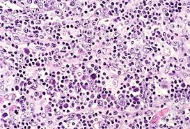 1,2 cutaneous lesions may manifest as a pruritic. Angioimmunoblastic T Cell Lymphoma 7