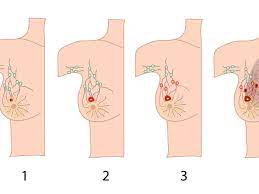 Kanker payudara (kpd) merupakan keganasan pada jaringan payudara yang dapat berasal dari epitel duktus maupun lobulusnya.kanker payudara merupakan salah satu jenis kanker terbanyak di. Ciri Ciri Kanker Payudara Sesuai Stadium