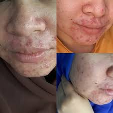 Tati 5 dalam 1 didapati ada 20,000 merkuri, bahan kimia beracun yang berbahaya. Pengalaman Ngeri Selepas Guna Produk Ta Skincare Lekat Lekit Story