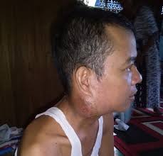 Kelenjar bisa sebagai sebagai kanker primer, dimana kelenjar getah bening adalah bagian pertama tubuh yang terkena kanker. Nassoha Penderita Kelenjar Getah Bening Koranbanjar Net